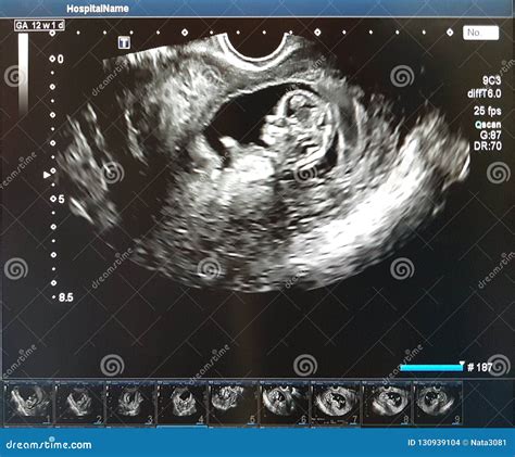 ultrasound dating accuracy first trimester